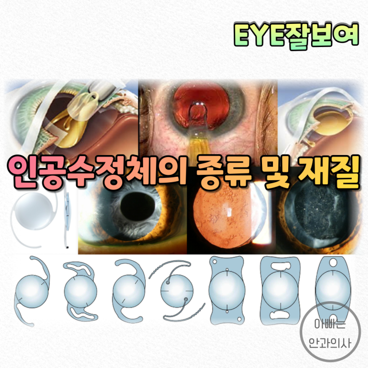  [EYE잘보여] 인공수정체는 어떤 것들이 있을까? - 인공수정체(IntraOcular Lens; IOL)의 종류 및 재질