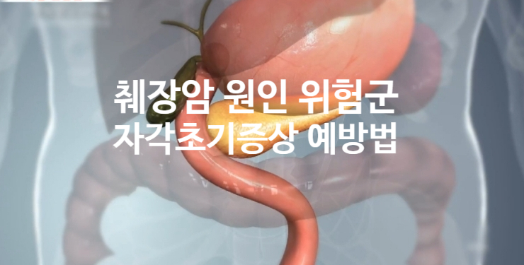  췌장암 원인 자각 초기 증상 (ft. 고위험군 예방법) 원인불명의 복통 등통증
