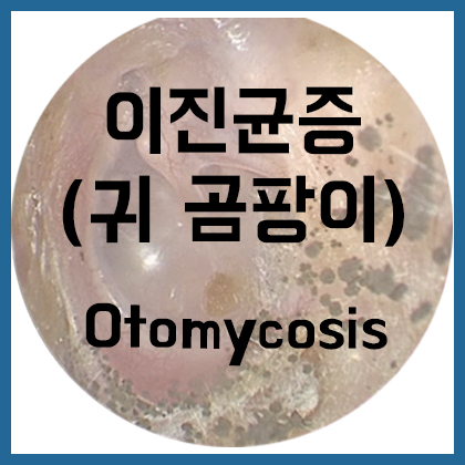  [귀] 이 진균증(귀 곰팡이)-Otomycosis