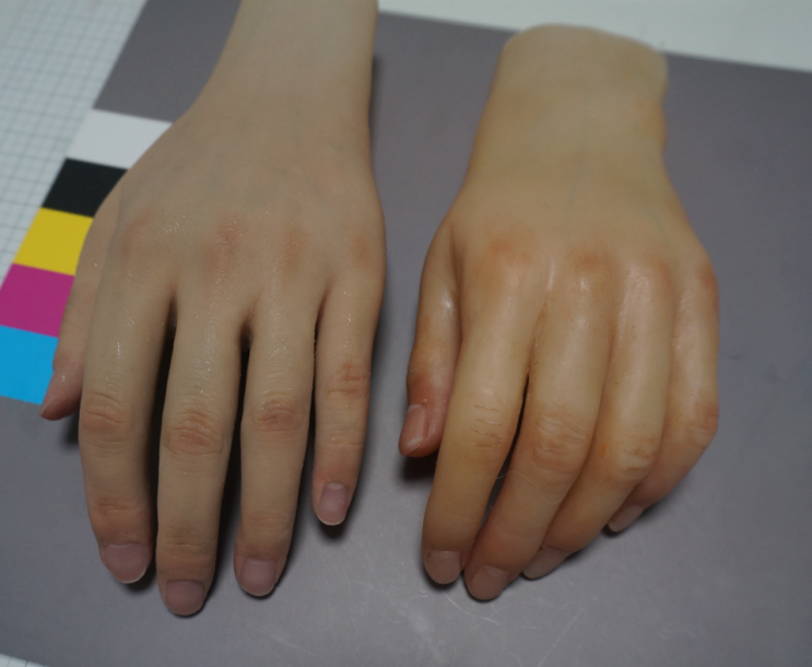  일본의 의수를 뛰어넘는 대단한 퀄리티! 실로바이오닉 의수!