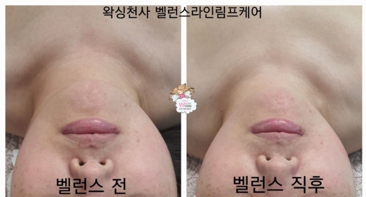 왁싱<b>천사</b> 비대칭<b>얼굴</b>관리