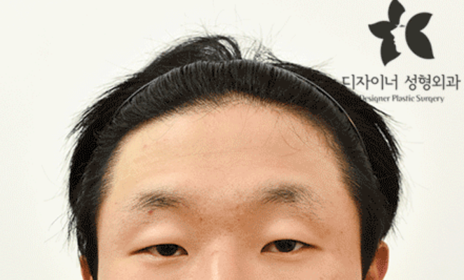 남자 속쌍 이럴 때 좋다. (수술이 필요할 때? 연예인) : 네이버 블로그