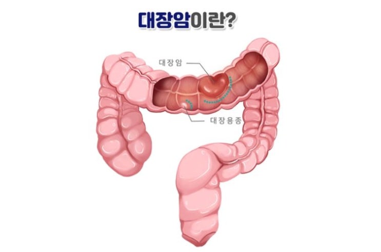  대장암 예방 및 치료에 좋은 음식 7가지