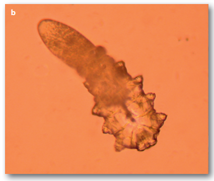  모낭충(Demodex)의 제거법? 관리와 치료!