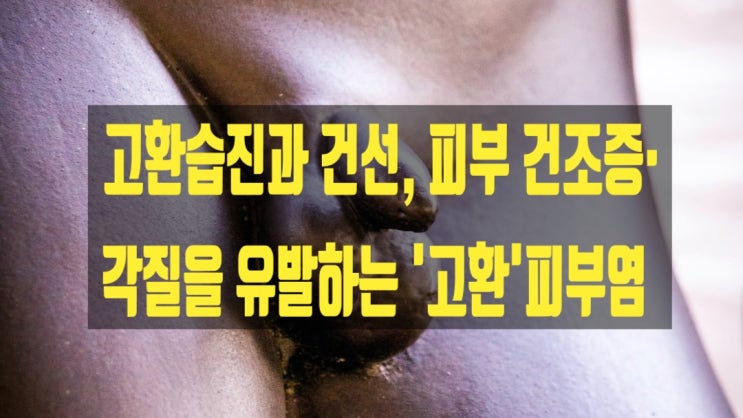  고환습진과 건선, 피부 건조증·각질을 유발하는 '고환'피부염