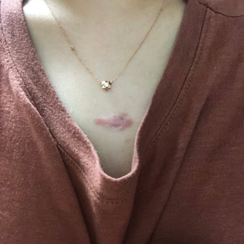 대전/서울 켈로이드 주사 치료 후기-3