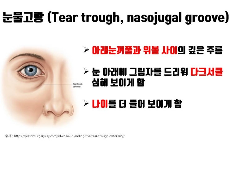  눈밑지방재배치는 어떤 지방을 어디로 재배치하는 건가요?