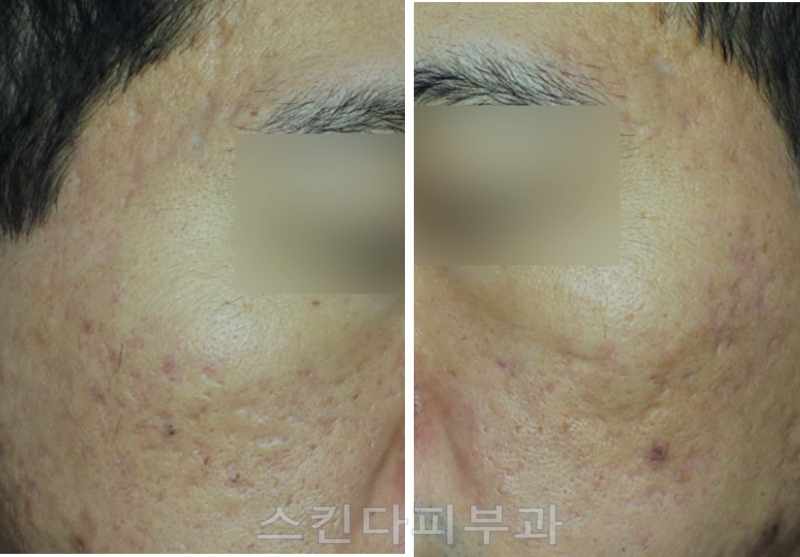 여드름흉터 롤링형흉터 피코프락셀Mla,Doe/쥬베룩/시크릿/서브시전 복합치료사례 : 네이버 블로그