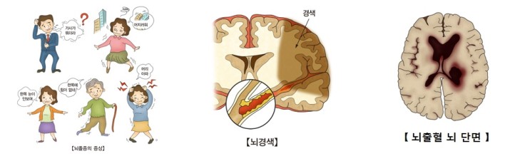 [뇌졸중]혈관이 터져서 생긴 뇌졸중을 뇌출혈, 혈관이 막혀서 생긴 뇌졸중을 뇌경색이라고 합니다.