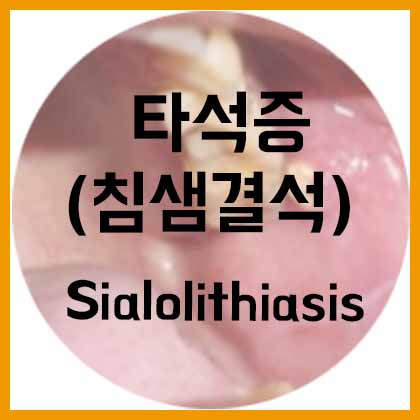  [목] 타석증(Sialoithiasis)