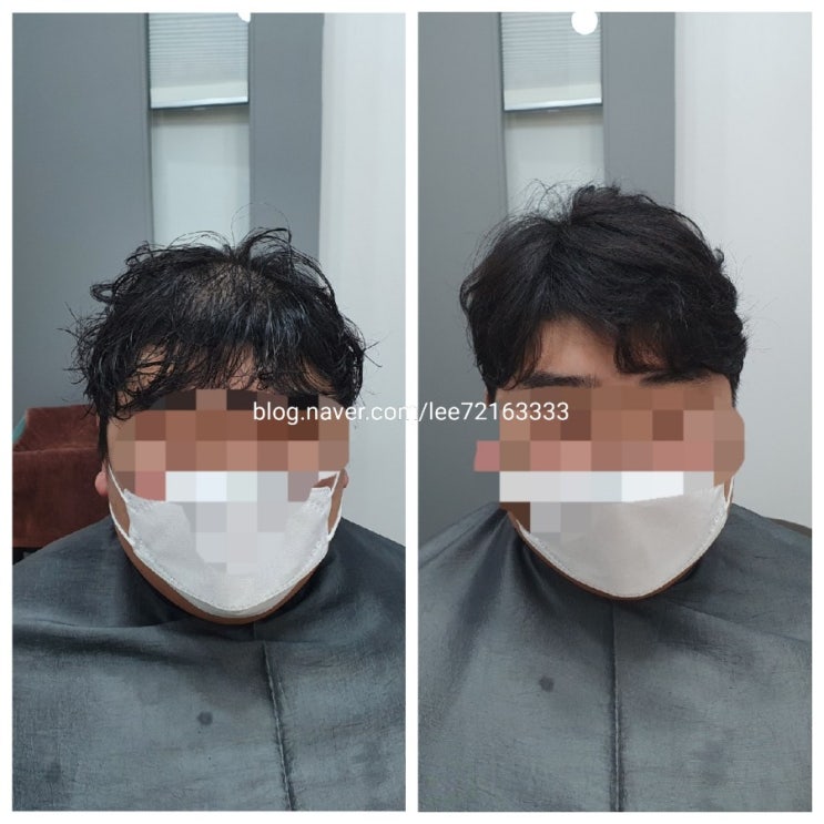  다증모술 보톡스증모술 장단점️ 부족한부분만채움 춘천가발전문점 김호증모