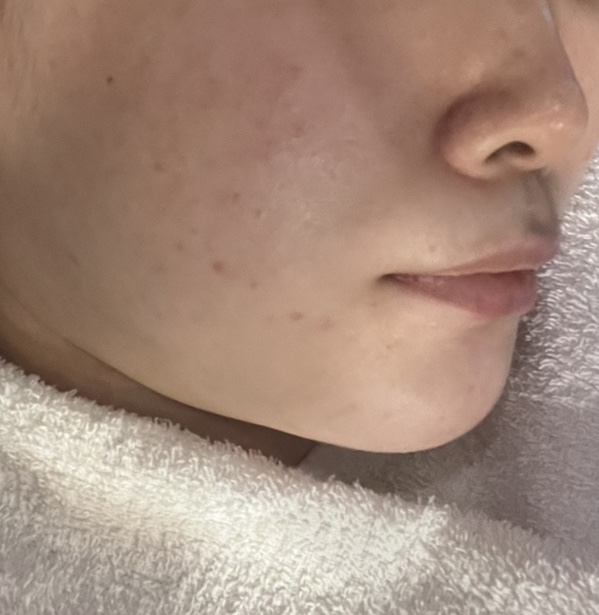  종로피부과에서 잡티제거 2회차 / VRM토닝
