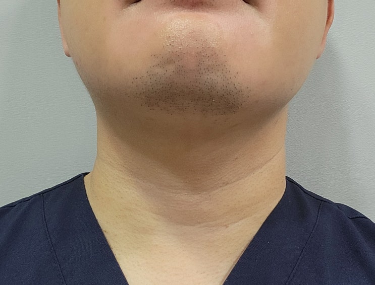  브이올렛주사 직접 시술받은 효과 및 한계점 - 삼성동 피부과전문의 닥터림