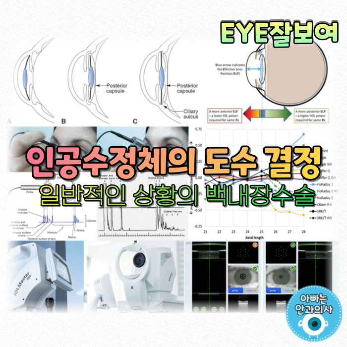 [EYE잘보여] 인공수정체의 도수 결정(1) - 일반적인 상황