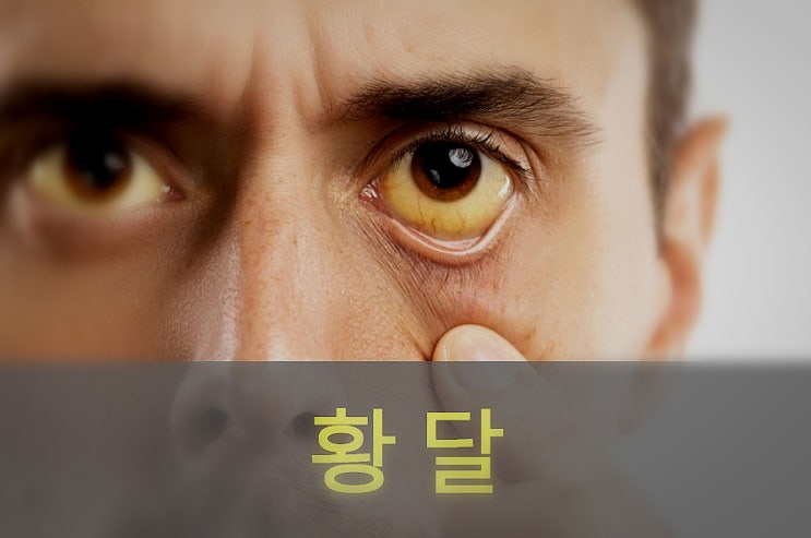  성인 황달 원인과 증상, 빌리루빈 수치