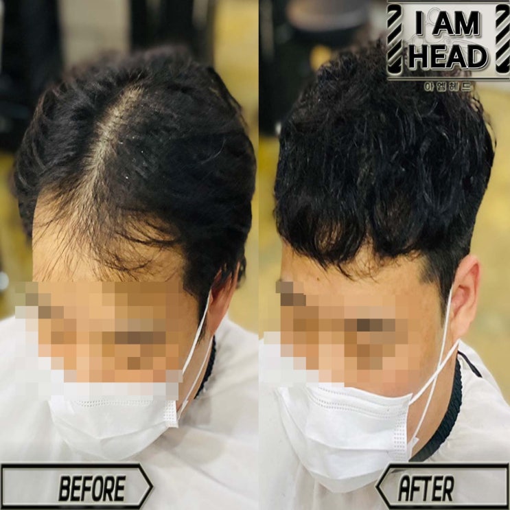  수원링거펌성지 아엠헤드에서 탈모커버 M펌 시술!!