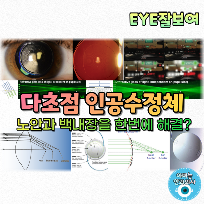 [EYE잘보여] 백내장 수술로 노안도 치료한다고? (1) - 다초점인공수정체, 노안인공수정체: 기본개념을 알아봅시다.
