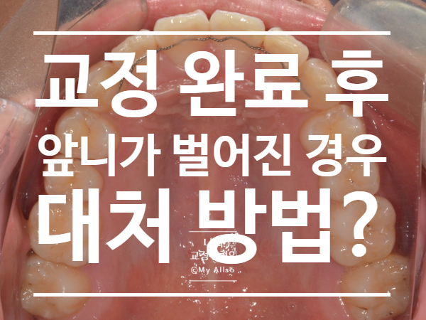 치아 교정을 마치고 나서  앞니가 다시 벌어졌을 때 대처 방법, 교정 끝나고 타치과에서 관리받는 방법