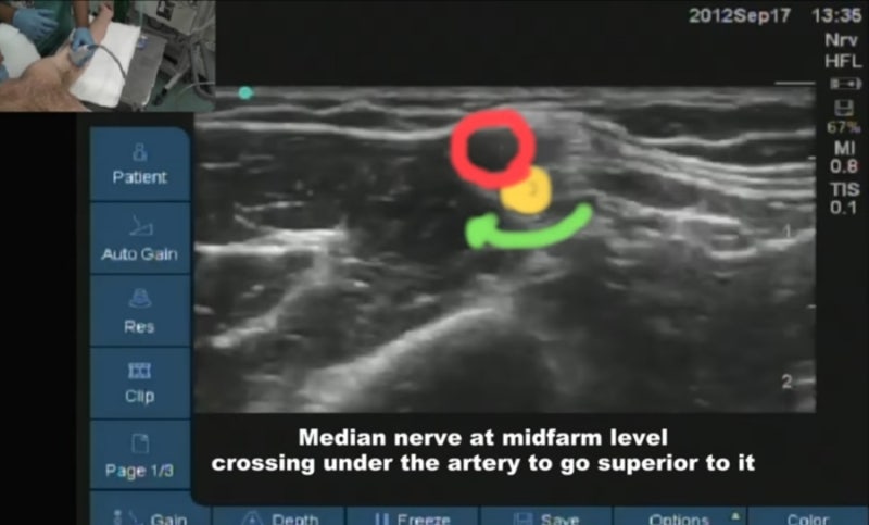 axillary brachial plexus block(BPB 액와 완신경총 차단술)의 모든 것 : 적응증, 해부학, 자세와 ...