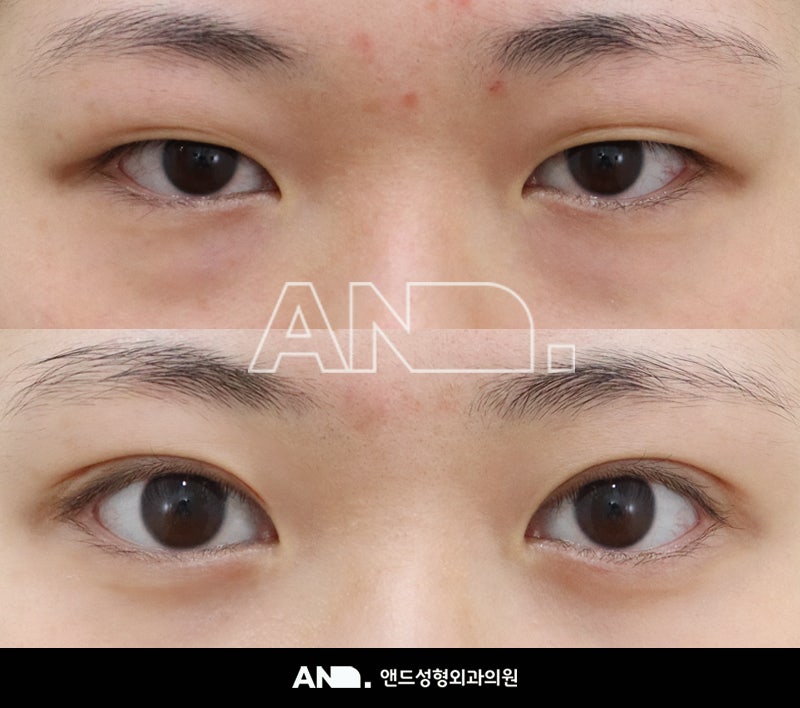 쌍꺼풀 절개법과 윗눈꺼풀 지방제거술을 소개합니다(쌍꺼풀 수술(쌍꺼풀 절개 + 앞트임)) 9