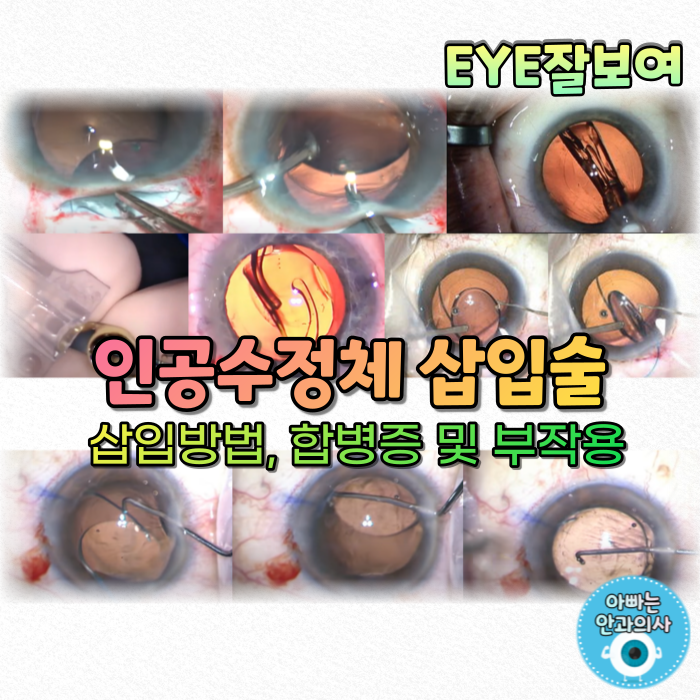  [EYE잘보여] 인공수정체 삽입술 - 삽입방법, 인공수정체 삽입 관련 합병증 및 부작용