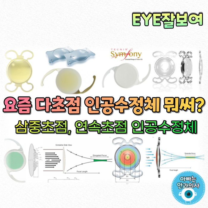  [EYE잘보여] 백내장 수술로 노안도 치료한다고? (2) - 삼중초점 인공수정체, 연속초점 인공수정체