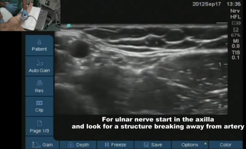 axillary brachial plexus block(BPB 액와 완신경총 차단술)의 모든 것 : 적응증, 해부학, 자세와 ...