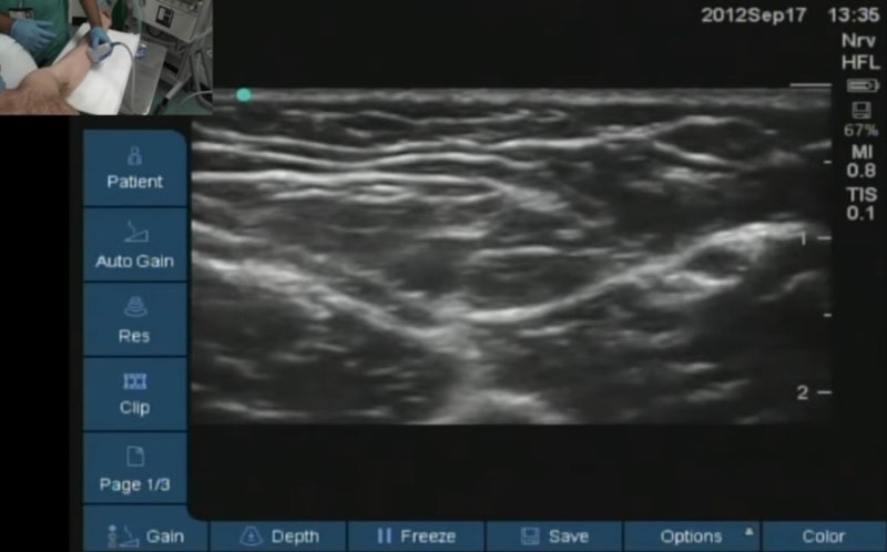 axillary brachial plexus block(BPB 액와 완신경총 차단술)의 모든 것 : 적응증, 해부학, 자세와 ...