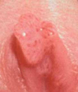 남자 곤지름 치료 방법은? : 네이버 블로그 남자 곤지름 치료 방법은? : 네이버 블로그