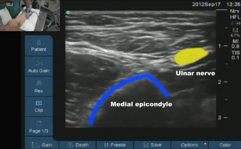 axillary brachial plexus block(BPB 액와 완신경총 차단술)의 모든 것 : 적응증, 해부학, 자세와 ...