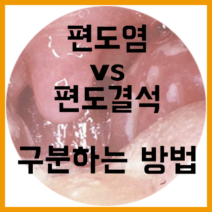  [목] 편도염 vs 편도결석, 무엇이 다를까?