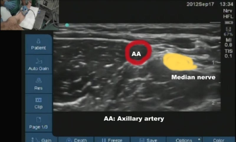 axillary brachial plexus block(BPB 액와 완신경총 차단술)의 모든 것 : 적응증, 해부학, 자세와 ...
