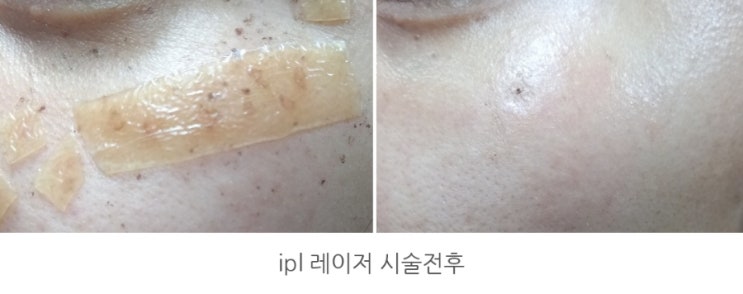 ipl 레이저 시술후기 주근깨 흑자제거 완전 만족해요