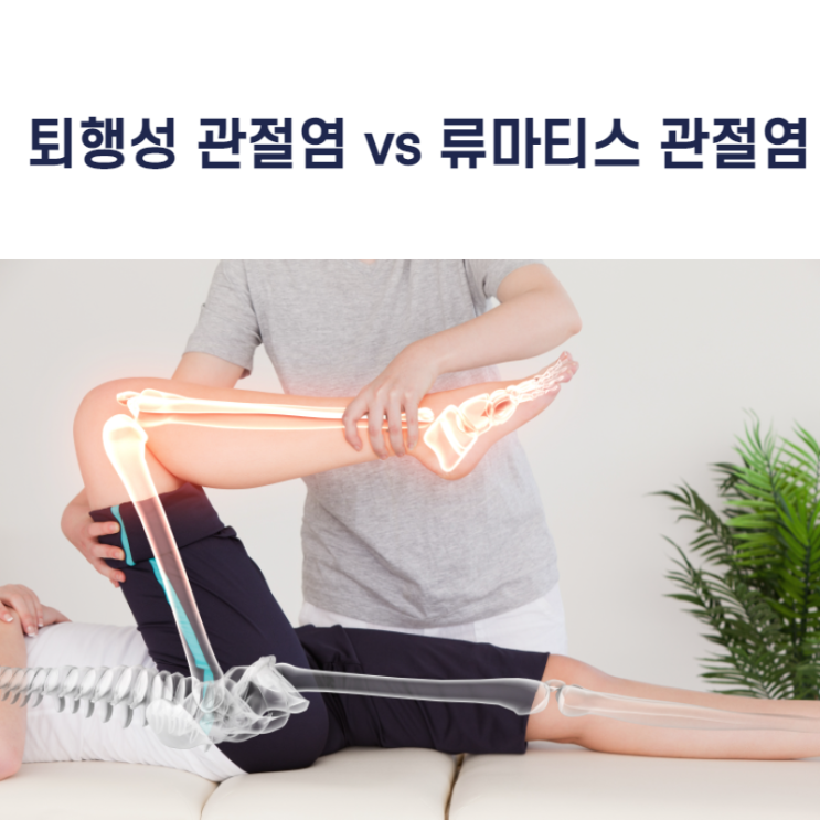  퇴행성 관절염 vs 류마티스 관절염(증상 및 진단 기준)차이점