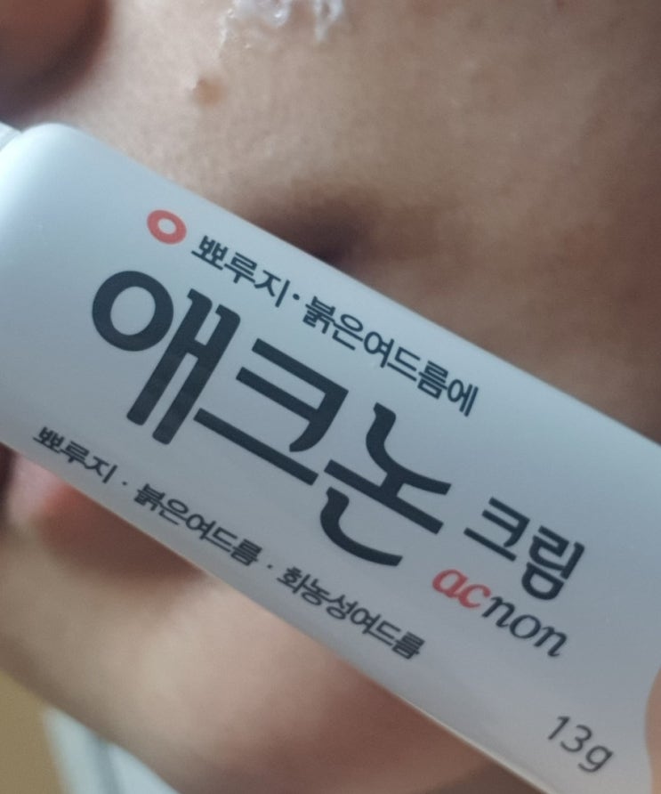  [여드름 복합성 피부/내돈내산] 뾰루지 여드름에 애크논 크림 찐 사용 후기(동생에 이어..)