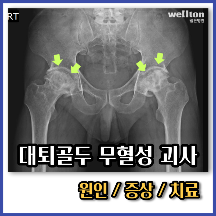 대퇴골두 무혈성 괴사 원인, 단계별 증상과 치료