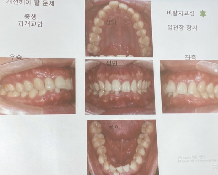 30대 중반 교정일기 시작 D-2