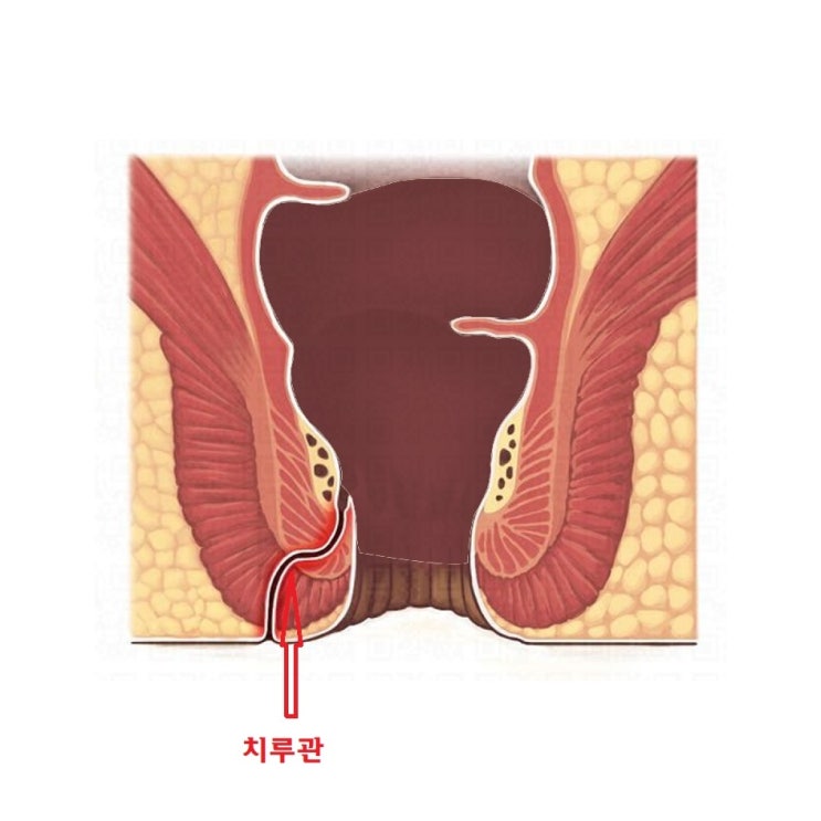  치루의 치료