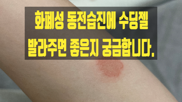 화폐성 동전습진에 수딩젤 발라주면 좋은지 궁금합니다.