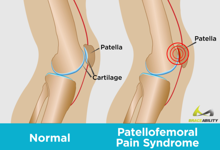 [서래마을PT]무릎통증,슬개대퇴통증증후군(PFPS)