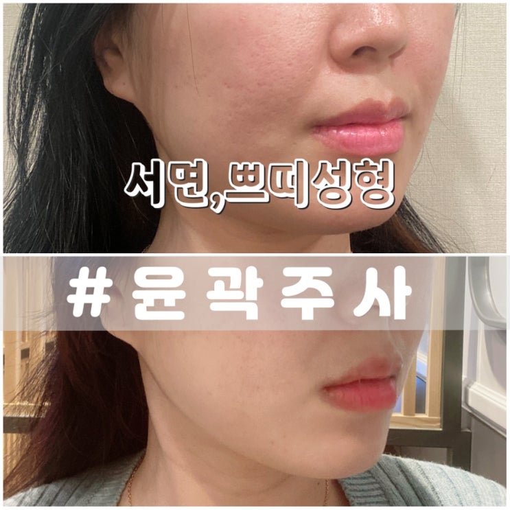  서면 윤곽주사 후기 전후비교/ 부산 윤곽주사 내돈내산 솔직후기