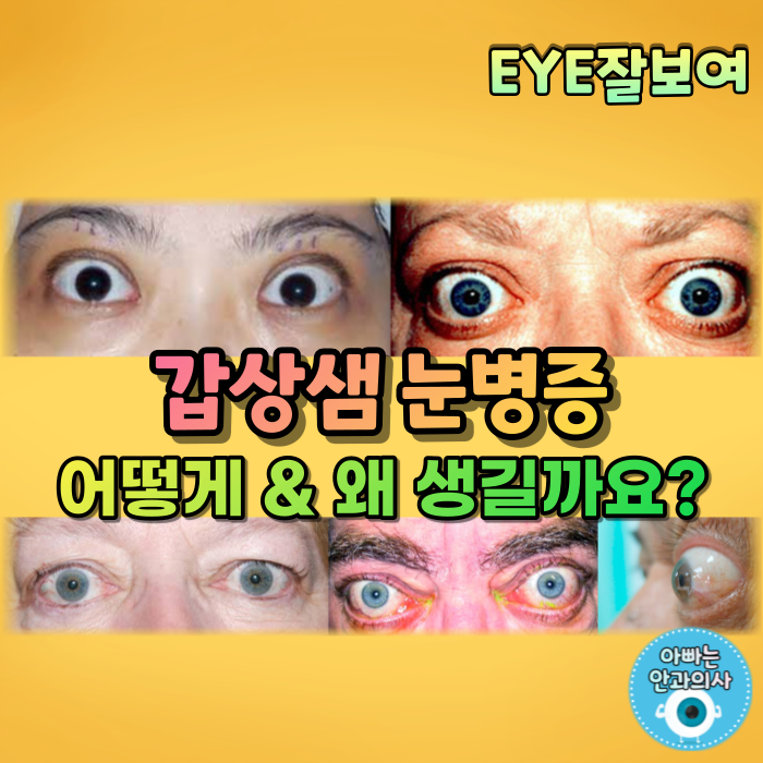 [EYE잘보여] 갑상샘 눈병증, 갑상선 안병증 (1) - 발병기전, 역학적 특성, 원인