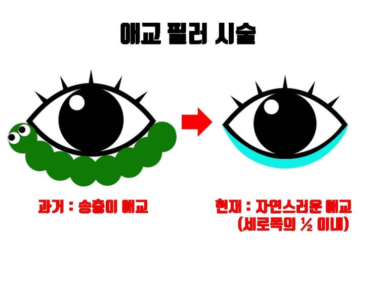  눈수술보다 성형시술이 더 많이 시행되는 유일한 눈성형은 바로 눈밑애교!!!