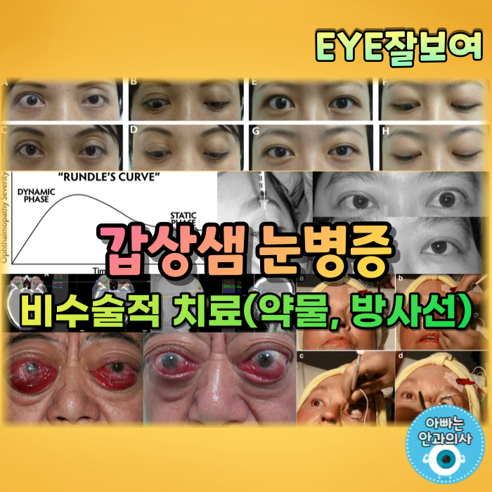 [EYE잘보여] 갑상샘 눈병증, 갑상선 안병증 (4) - 비수술적 치료, 보존적 치료, 내과적 치료, 약물 치료