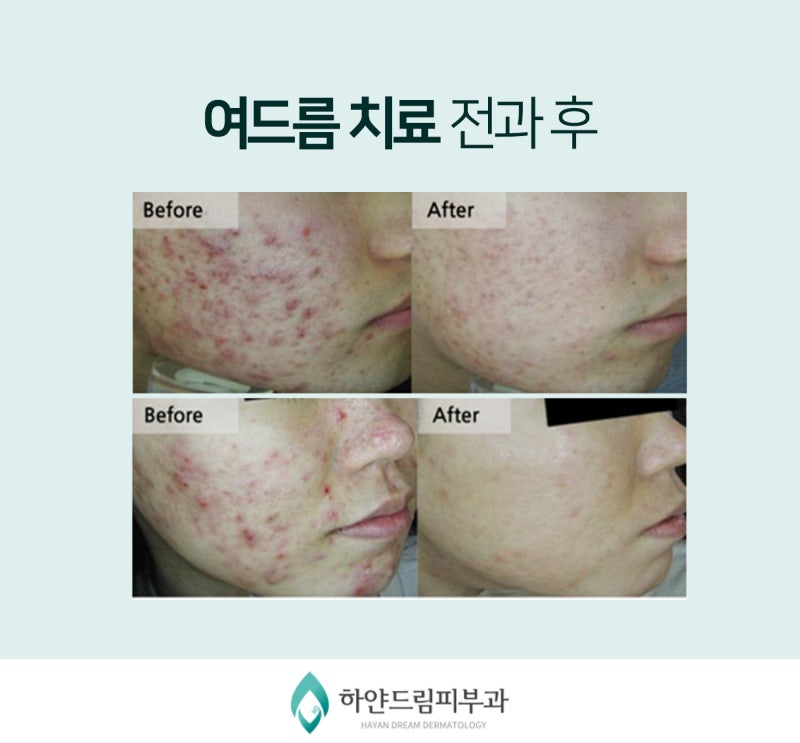 청주여드름피부과 여드름 개선되려면 3