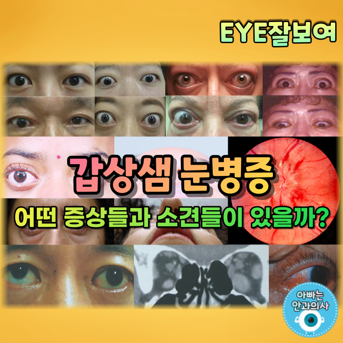 [EYE잘보여] 갑상샘 눈병증, 갑상선 안병증 (2) - 임상양상(증상, 징후)