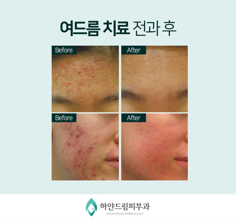 청주여드름피부과 여드름 개선되려면