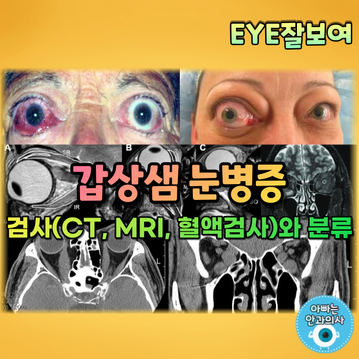 [EYE잘보여] 갑상샘 눈병증, 갑상선 안병증 (3) - 진단 및 검사, 분류체계