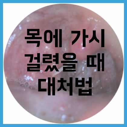  목에 가시가 걸리면 어떻게 해야할까?