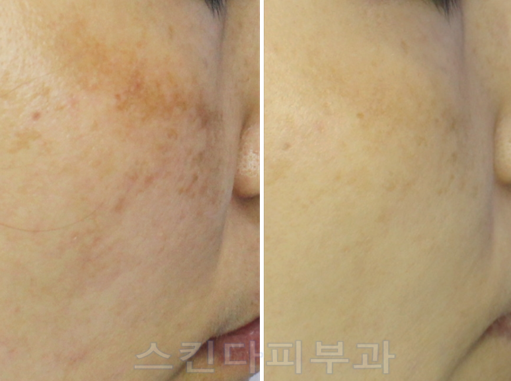 피부과 기미치료 기미시술 레이저토닝과 그 부작용에 대하여 3